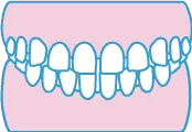 空隙歯列